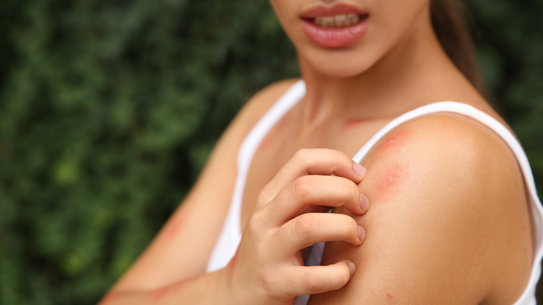 woman with bug bite