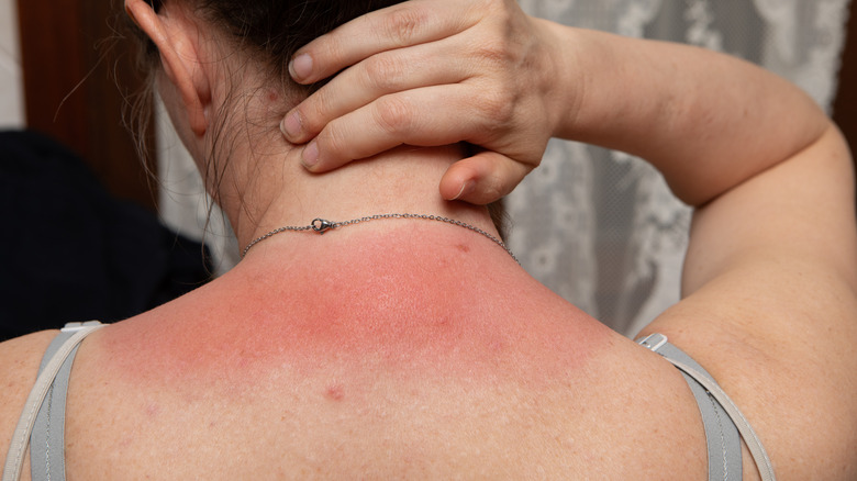 Woman applying moisturizer on sunburned neck
