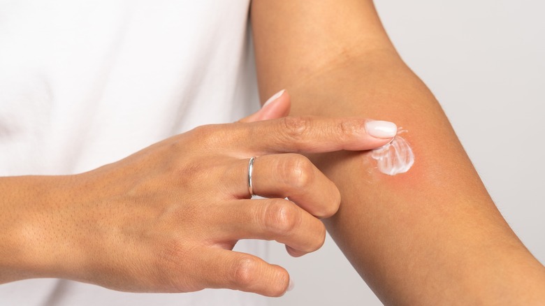 Person putting cream on an itch