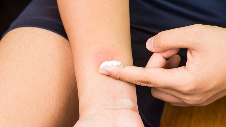 hand applying paste to bite