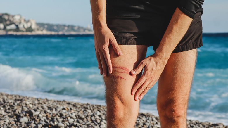 Jellyfish sting on the leg